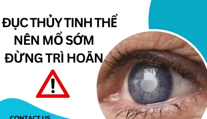 ĐỤC THỦY TINH THỂ : NÊN MỔ SỚM ĐỪNG TRÌ HOÃN
