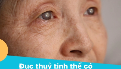 Đục thủy tinh thể mắt có chữa được không? Nguyên nhân, Triệu chứng và Giải pháp điều trị hiệu quả
