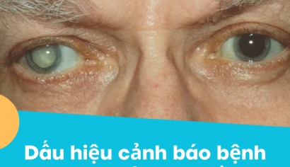 Dấu hiệu đục thủy tinh thể &amp; cách điều trị | BV Mắt Miền Đông