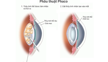 MỔ ĐỤC THUỶ TINH THỂ BẰNG PHẪU THUẬT PHACO TẠI BỆNH VIỆN MẮT MIỀN ĐÔNG – BÀ RỊA