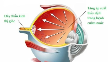 Bệnh Glaucoma (Cườm nước, Thiên đầu thống): Nguyên nhân, Triệu chứng và Cách điều trị